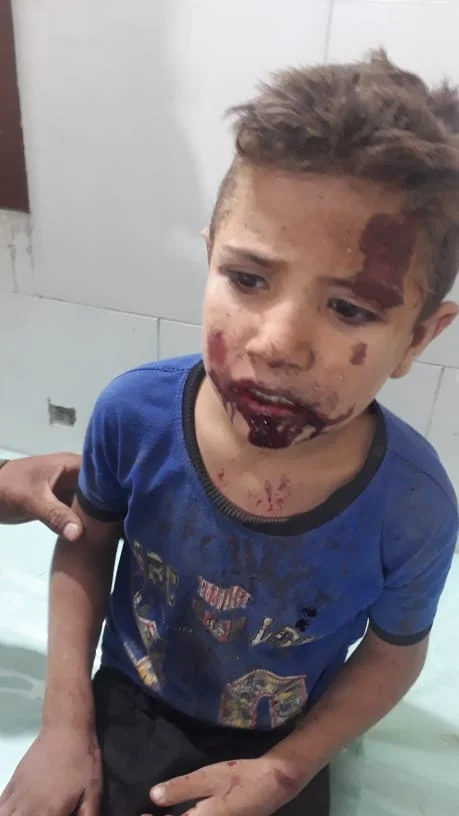طفل أصيب بقصف النظام السوري على ريف إدلب 20-102-2022