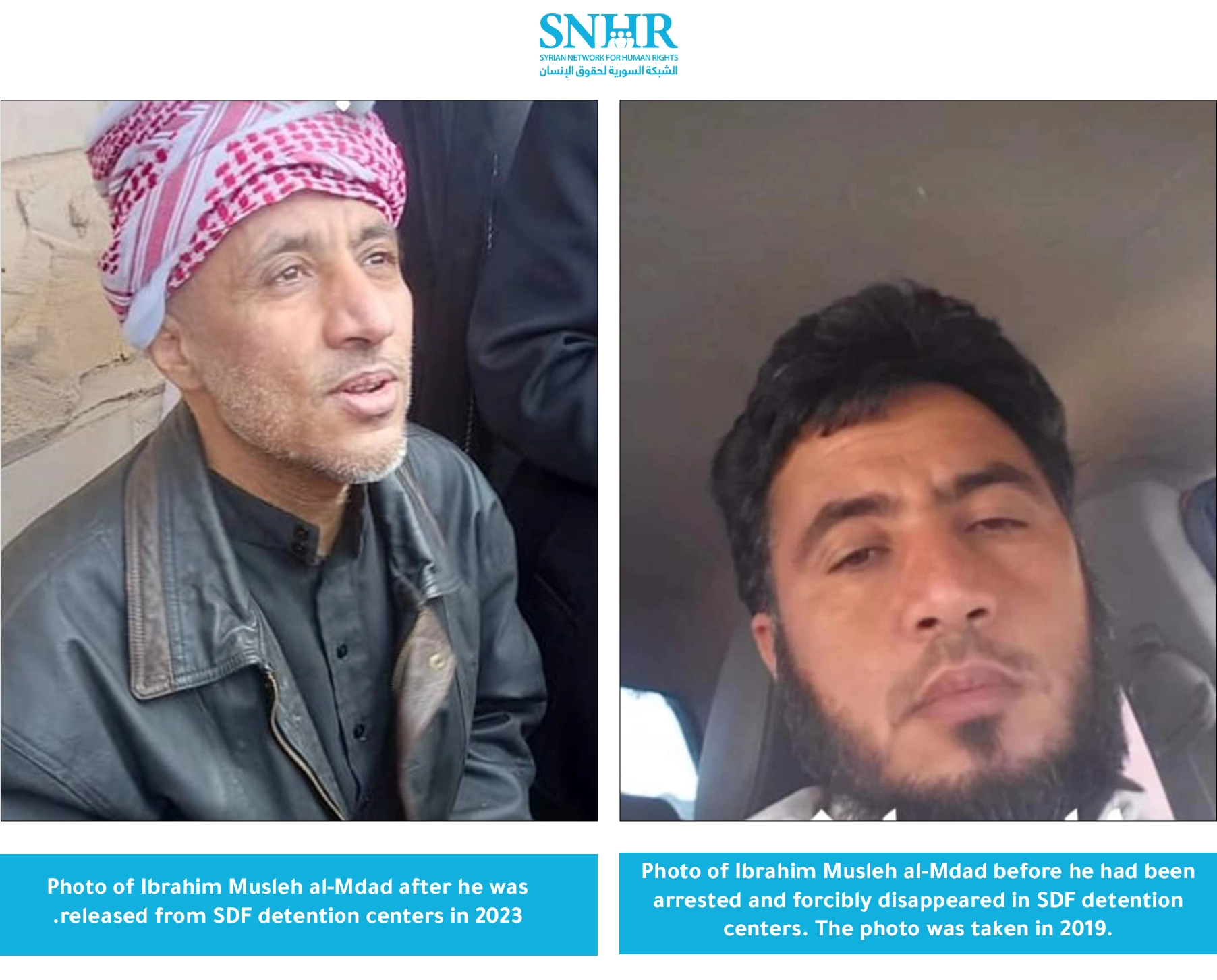 Before and after photos of a detainee recently released from an SDF detention center show  the medical negligence in SDF detention centers. 